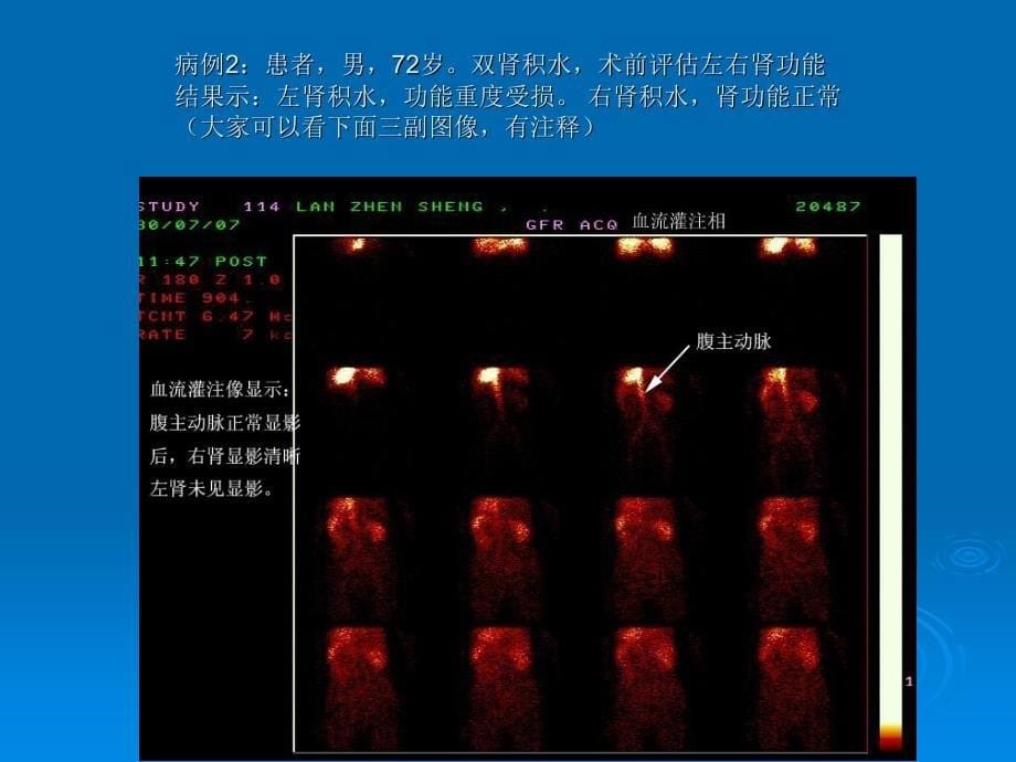 ECT肾功能显像的临床应用(肾图+肾小球滤过率测定).ppt_第5页