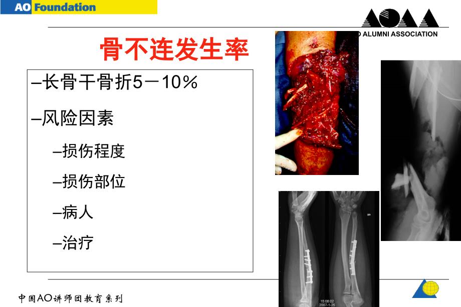 AO-骨不连和骨延迟愈合.ppt_第4页