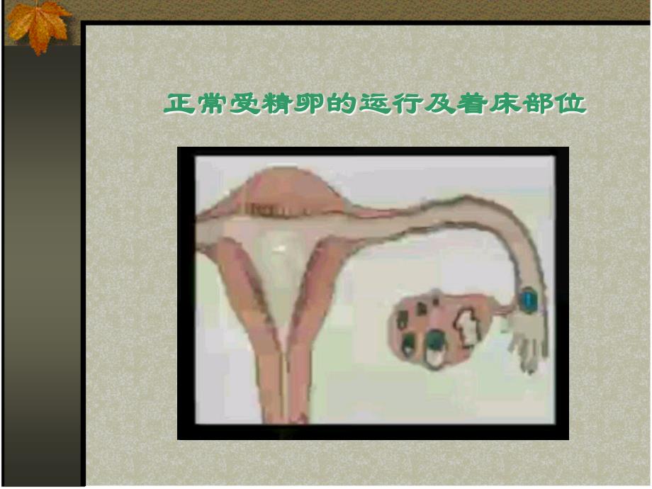 异位妊娠 PPT课件.ppt_第4页