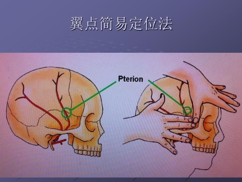 翼点入路解剖_第5页