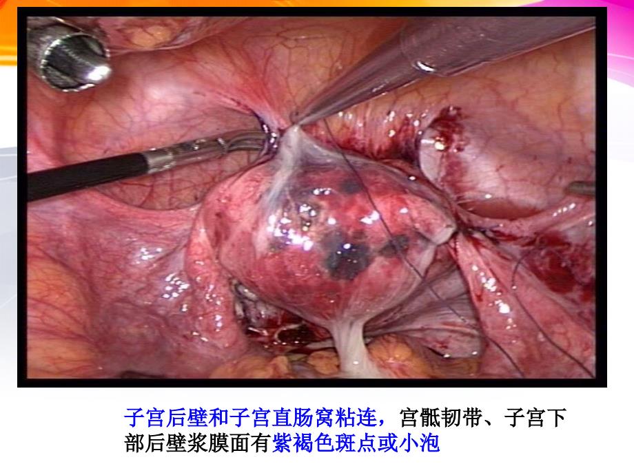 培训资料-子宫内膜异位_第4页