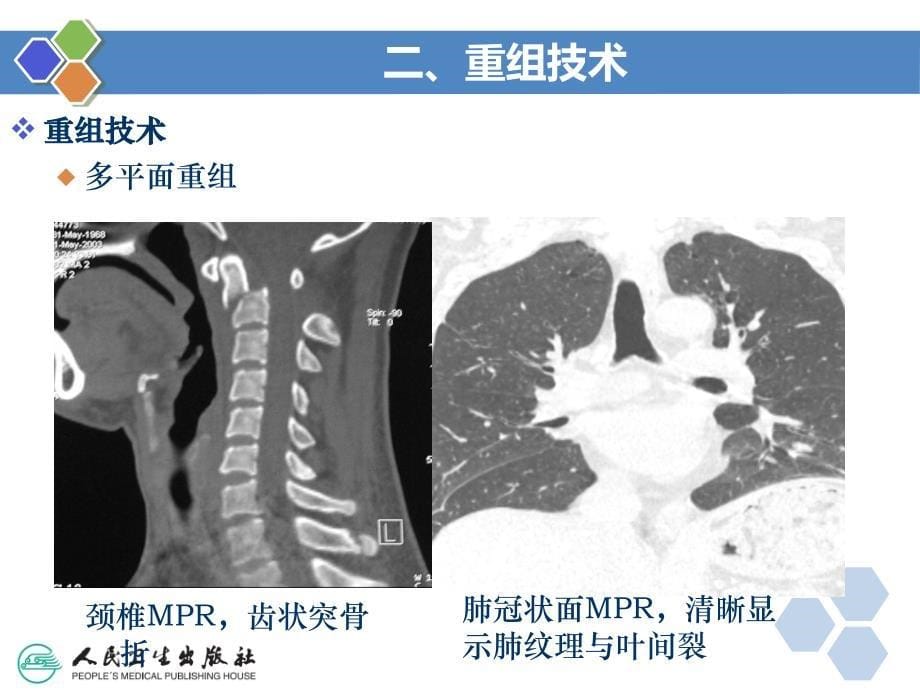 CT图像后处理技术课件_第5页