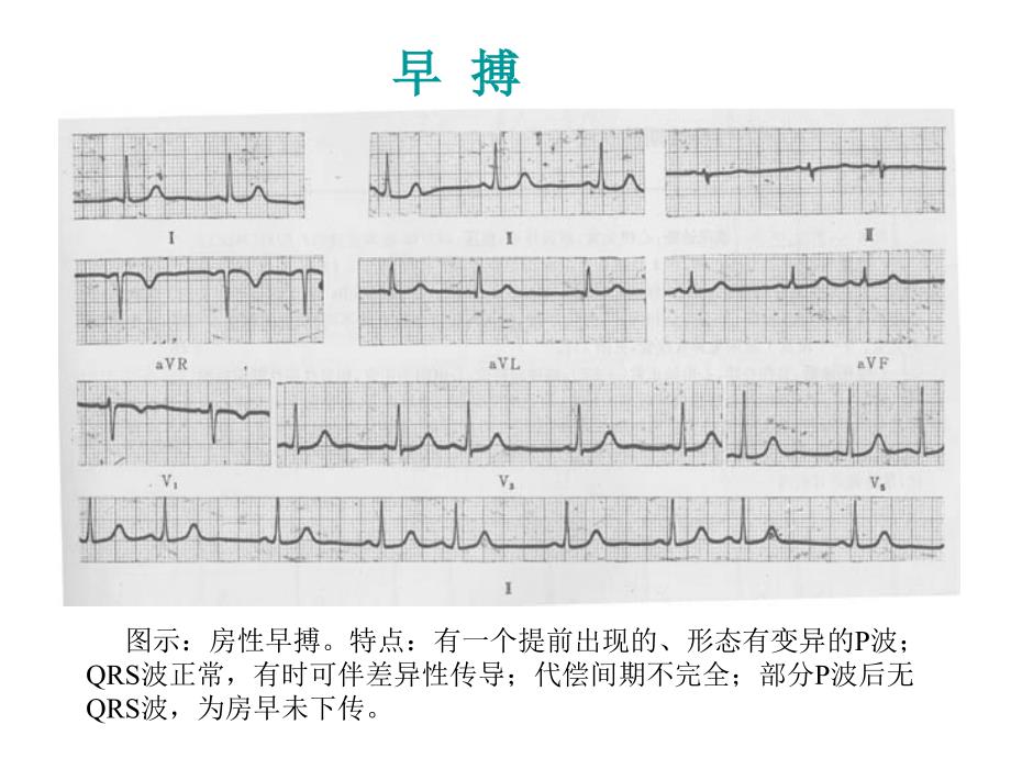 最新：复杂心电图读片ppt课件文档资料_第1页