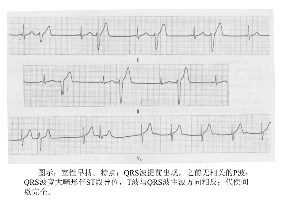 最新：复杂心电图读片ppt课件文档资料_第2页