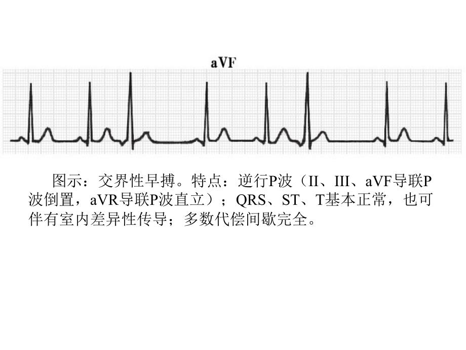 最新：复杂心电图读片ppt课件文档资料_第3页