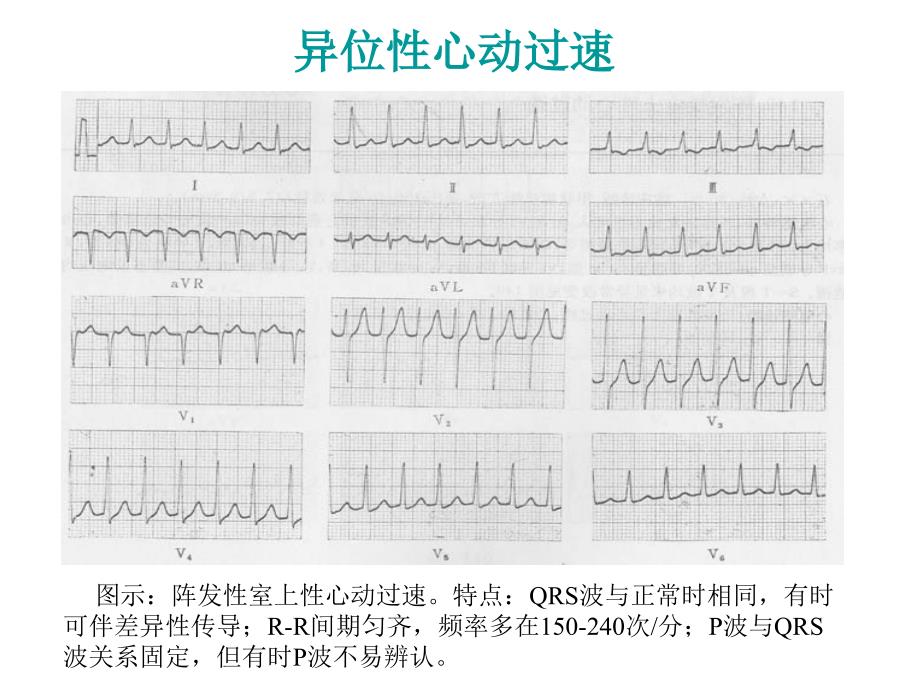 最新：复杂心电图读片ppt课件文档资料_第4页