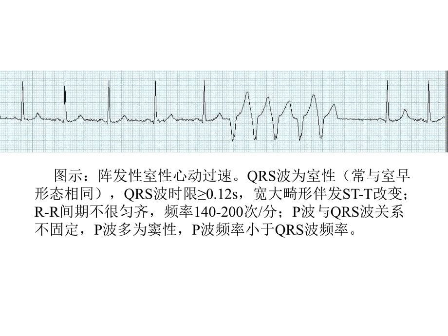 最新：复杂心电图读片ppt课件文档资料_第5页