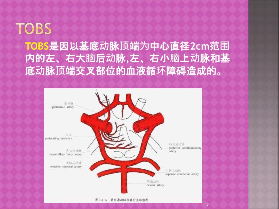 基底动脉尖综合征ppt演示课件_第3页