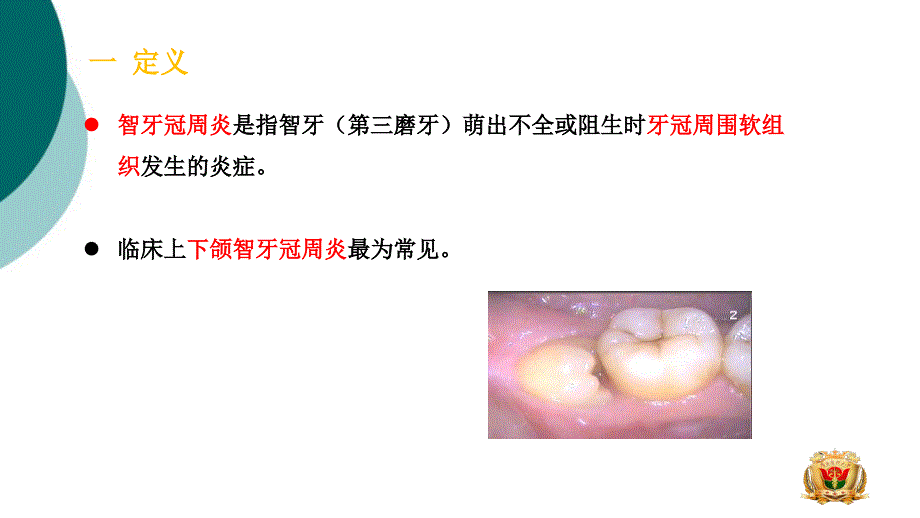 智牙冠周炎课件_第2页