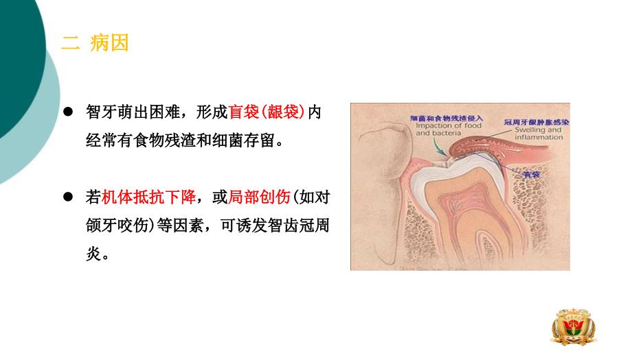 智牙冠周炎课件_第3页