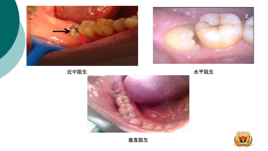 智牙冠周炎课件_第4页