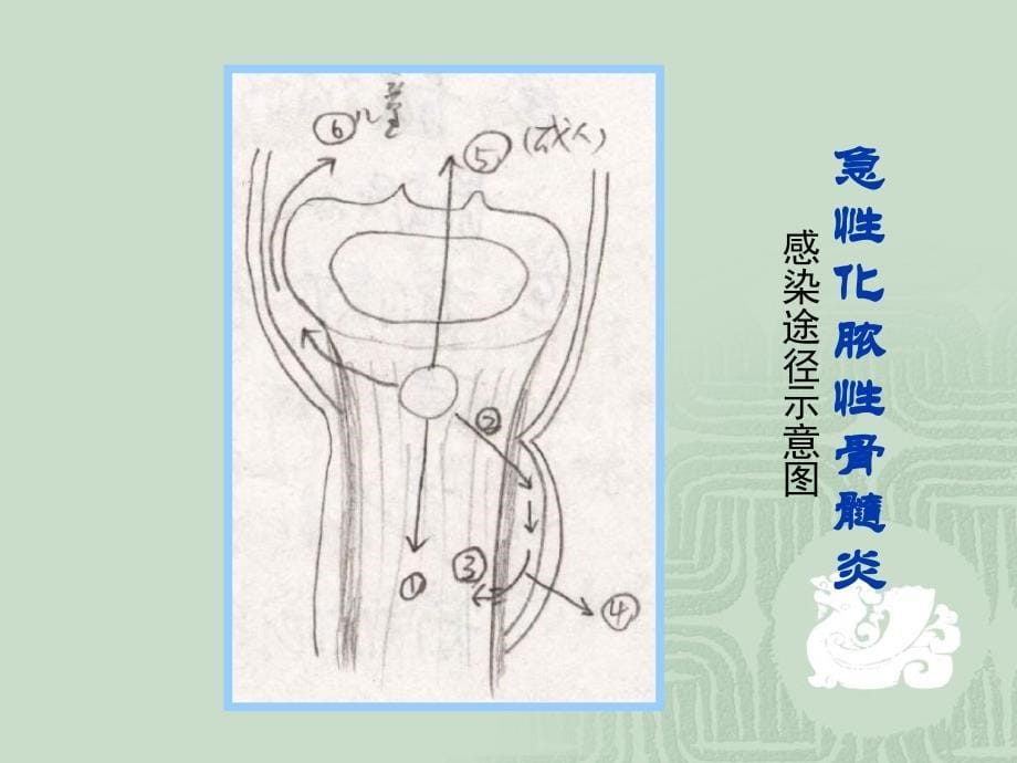 骨与软组织的感染PPT课件_第5页