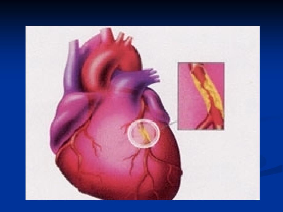 关于冠心病的课件PPT_第4页