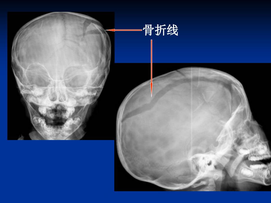 颅脑损伤的影像表现.ppt_第4页