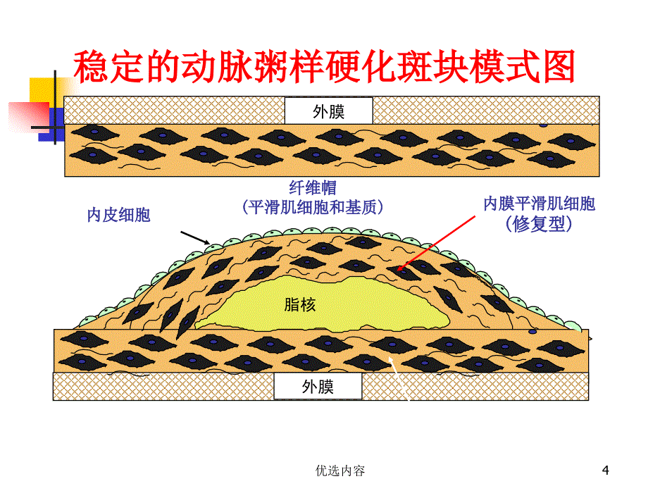 内科学稳定型心绞痛（业内荟萃）_第4页