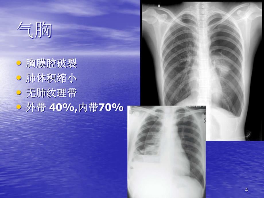 2015临床执业医师实践技能考试影像学(X线、CT、B超)精讲ppt课件_第4页