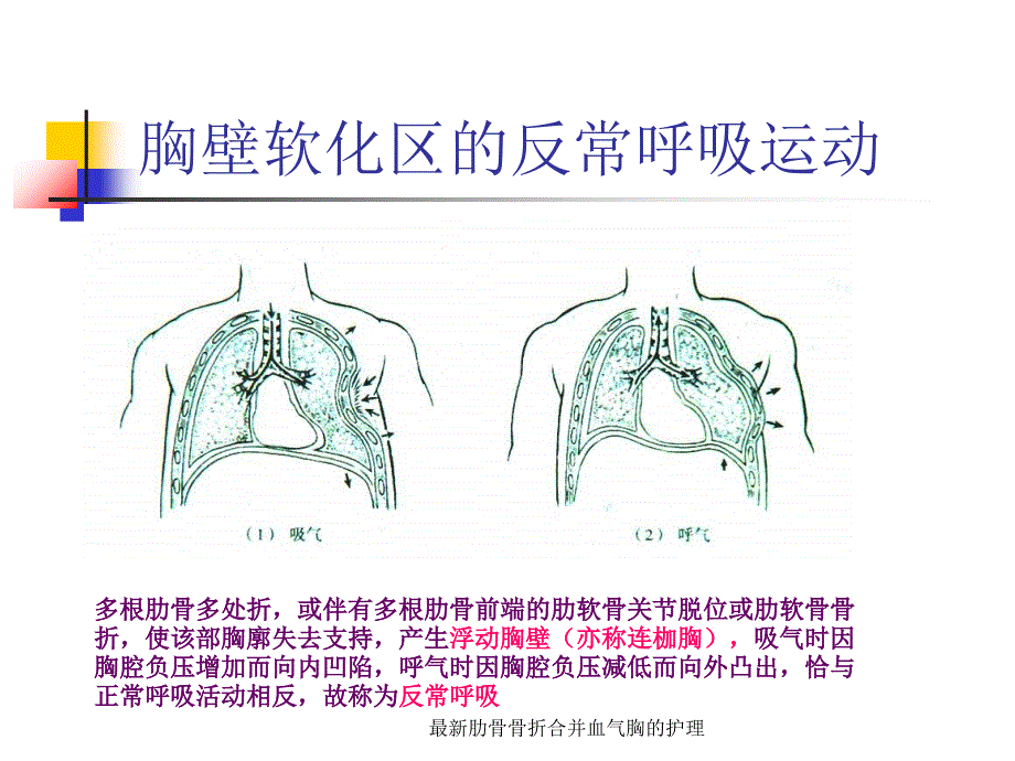 最新肋骨骨折合并血气胸的护理_第4页