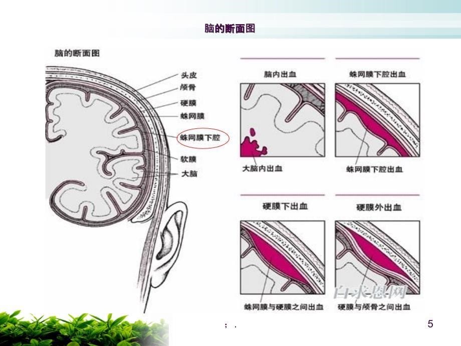 脑脊液耳漏的护理ppt课件_第5页