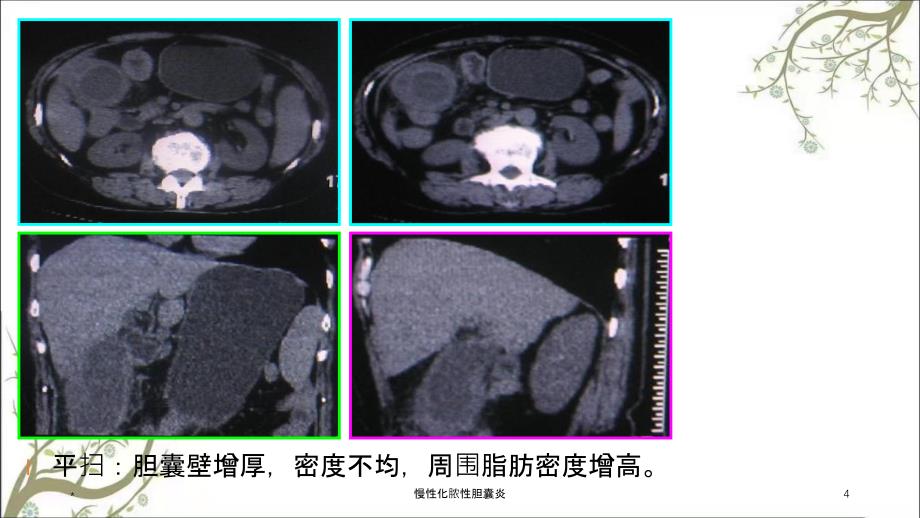 慢性化脓性胆囊炎课件_第4页