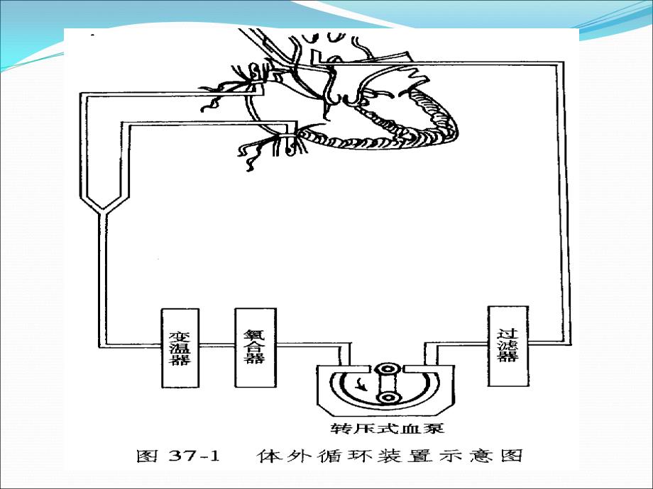 体外循环护理讲_第3页