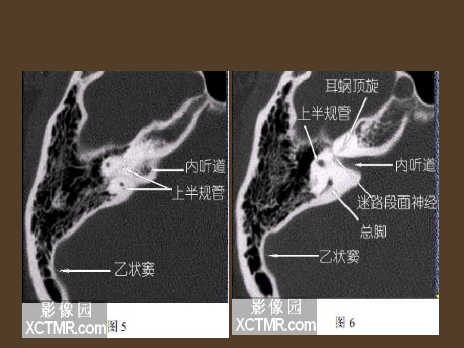 耳部解剖影像解剖应用ppt课件_第4页