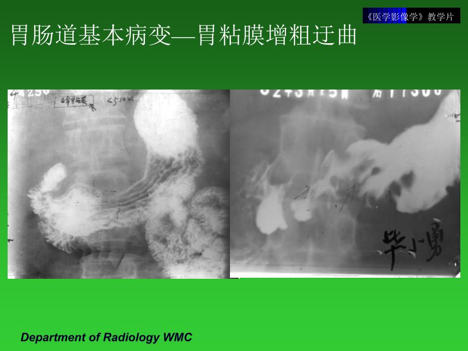 《医学影像学》实验课件（临床专业）：教学片5-消化系统2_第4页