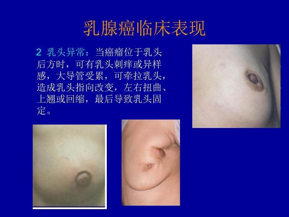 乳腺癌的X线诊断_第5页