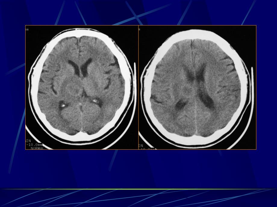 医学影像学：4中枢神经系统第二章第三节 脑感染性疾病_第3页