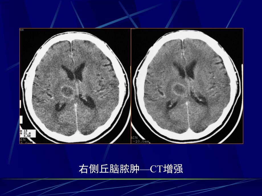 医学影像学：4中枢神经系统第二章第三节 脑感染性疾病_第4页