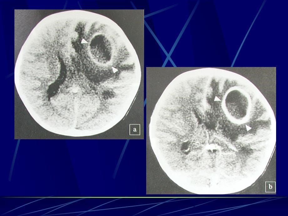 医学影像学：4中枢神经系统第二章第三节 脑感染性疾病_第5页