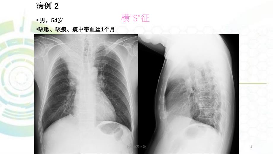 肺肿瘤及纵膈肿瘤ppt课件_第4页