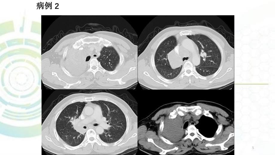 肺肿瘤及纵膈肿瘤ppt课件_第5页
