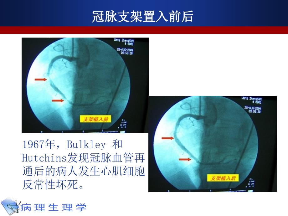 《病理生理学》课件：12 缺血-再灌注损伤_第3页