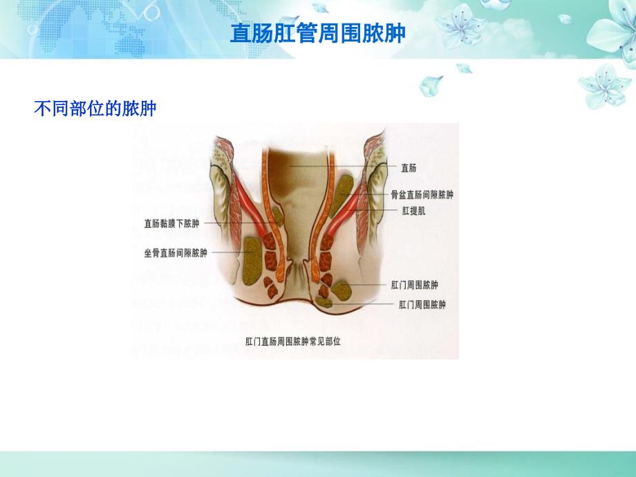 直肠肛管疾病病人的护理直肠肛管周围脓肿_第3页