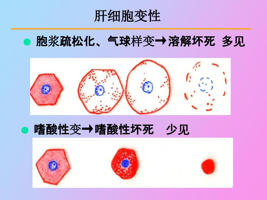 病毒性肝炎肝硬化_第4页