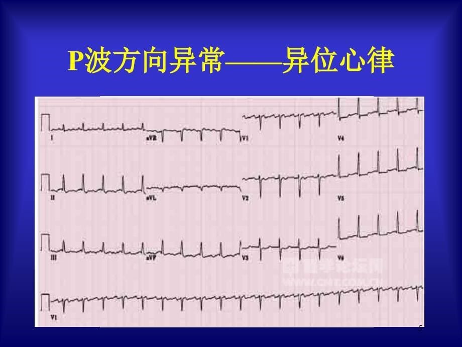 急诊常见心电图诊断要点ppt课件_第5页