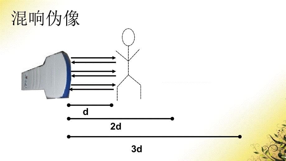 超声伪像的利与弊.ppt_第5页