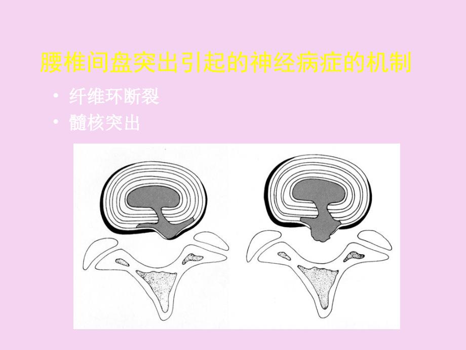 椎间盘突出症微创治疗方法选择ppt课件_第4页