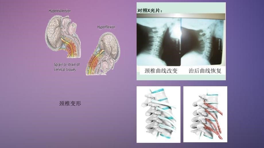 颈椎病与腰椎病tmp干货分享_第5页