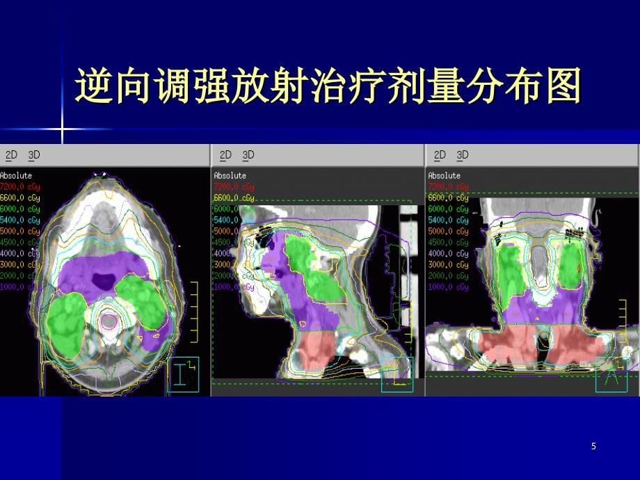 三维适形调强放疗计划的设计_第5页