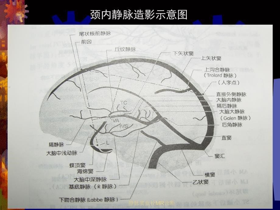 最新静脉窦血栓MR诊断_第5页