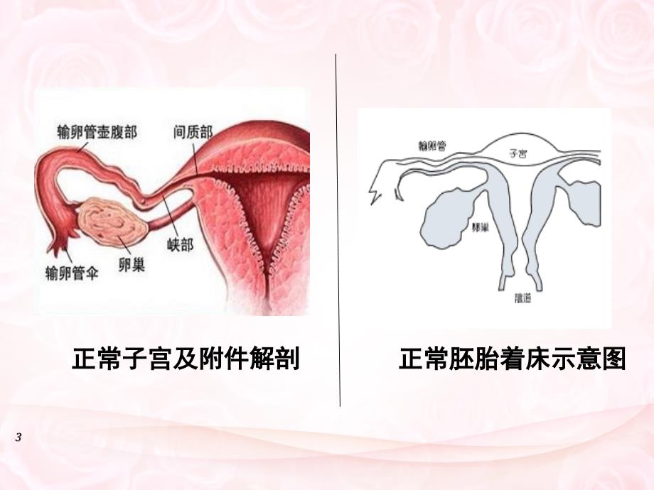 异位妊娠的护理课堂PPT_第3页