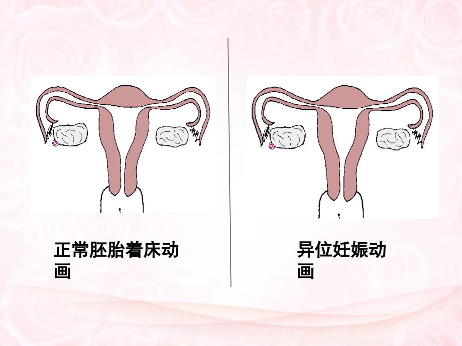 异位妊娠的护理课堂PPT_第4页