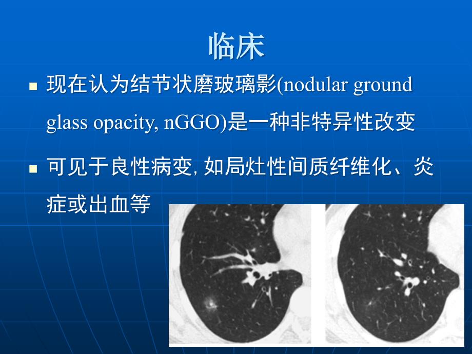 肺磨玻璃密度病变初步探讨PPT课件_第3页