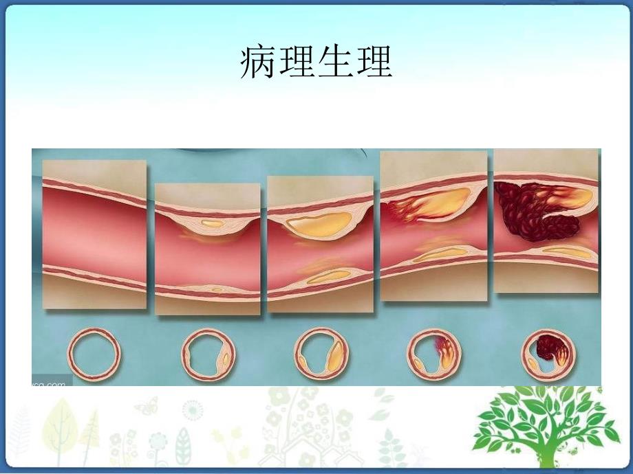 非ST段抬高型急性冠脉综合征诊断和治疗指南2016_第4页