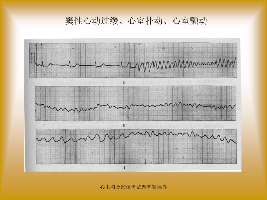 心电图及影像考试题答案课件_第4页