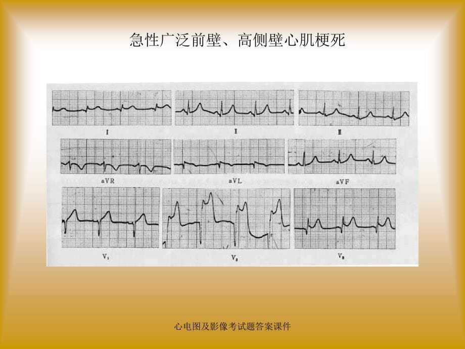 心电图及影像考试题答案课件_第5页