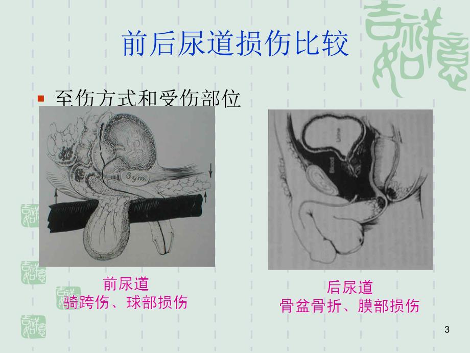 尿道损伤的治疗与护理PPT参考幻灯片.ppt_第3页