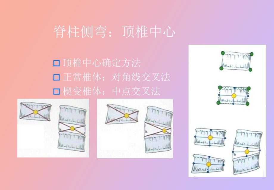 脊柱侧弯基础知识_第4页