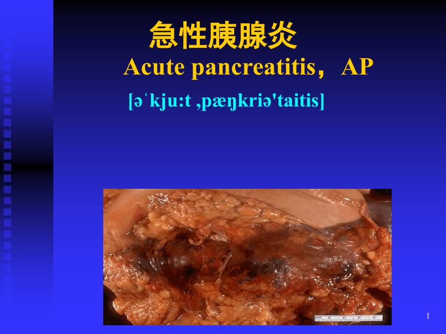 急性胰腺炎优精选幻灯片_第1页